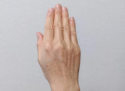 シミのある右手の甲